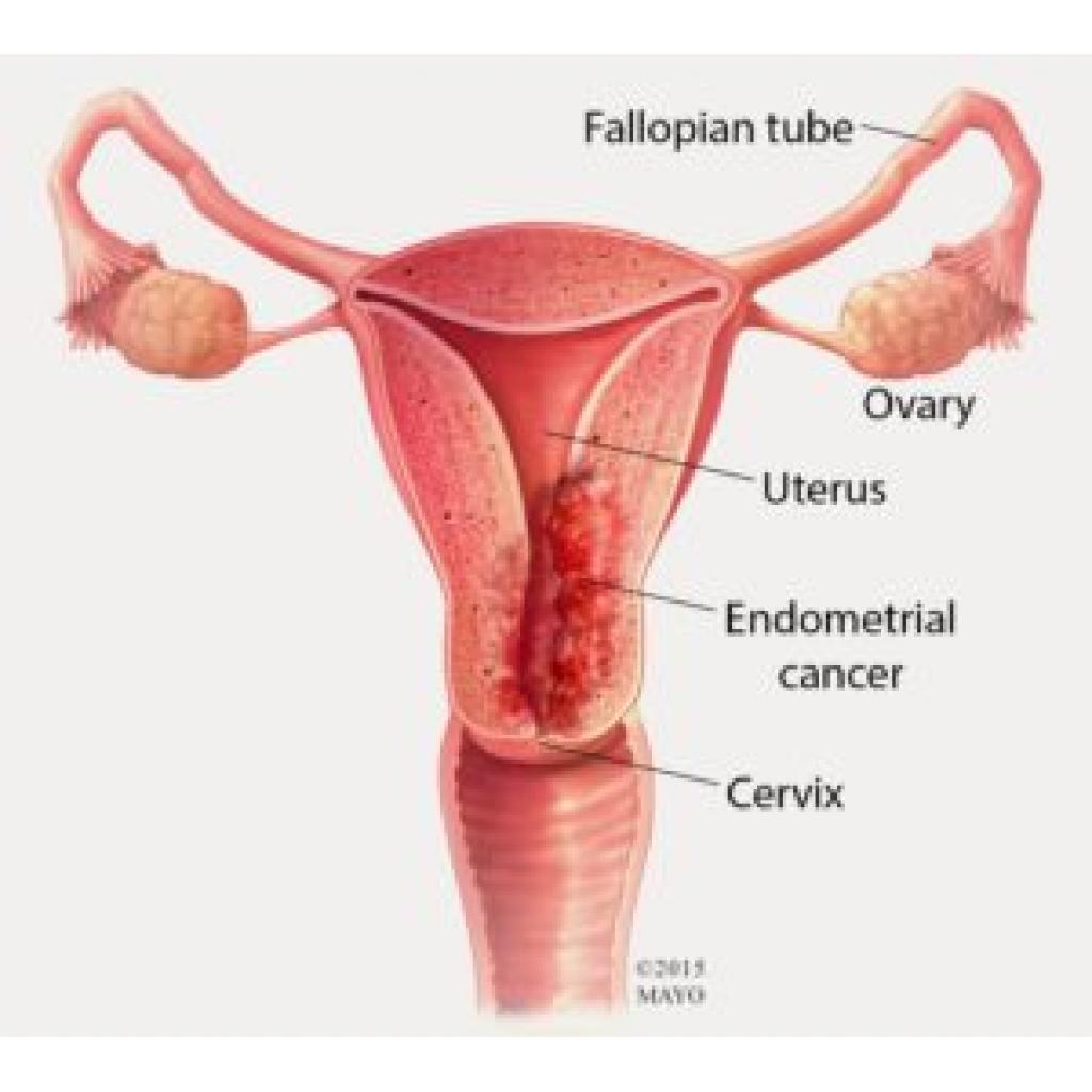 Hormon Replasman Tedavisinin Endometrium Kanseriyle İlişkisi