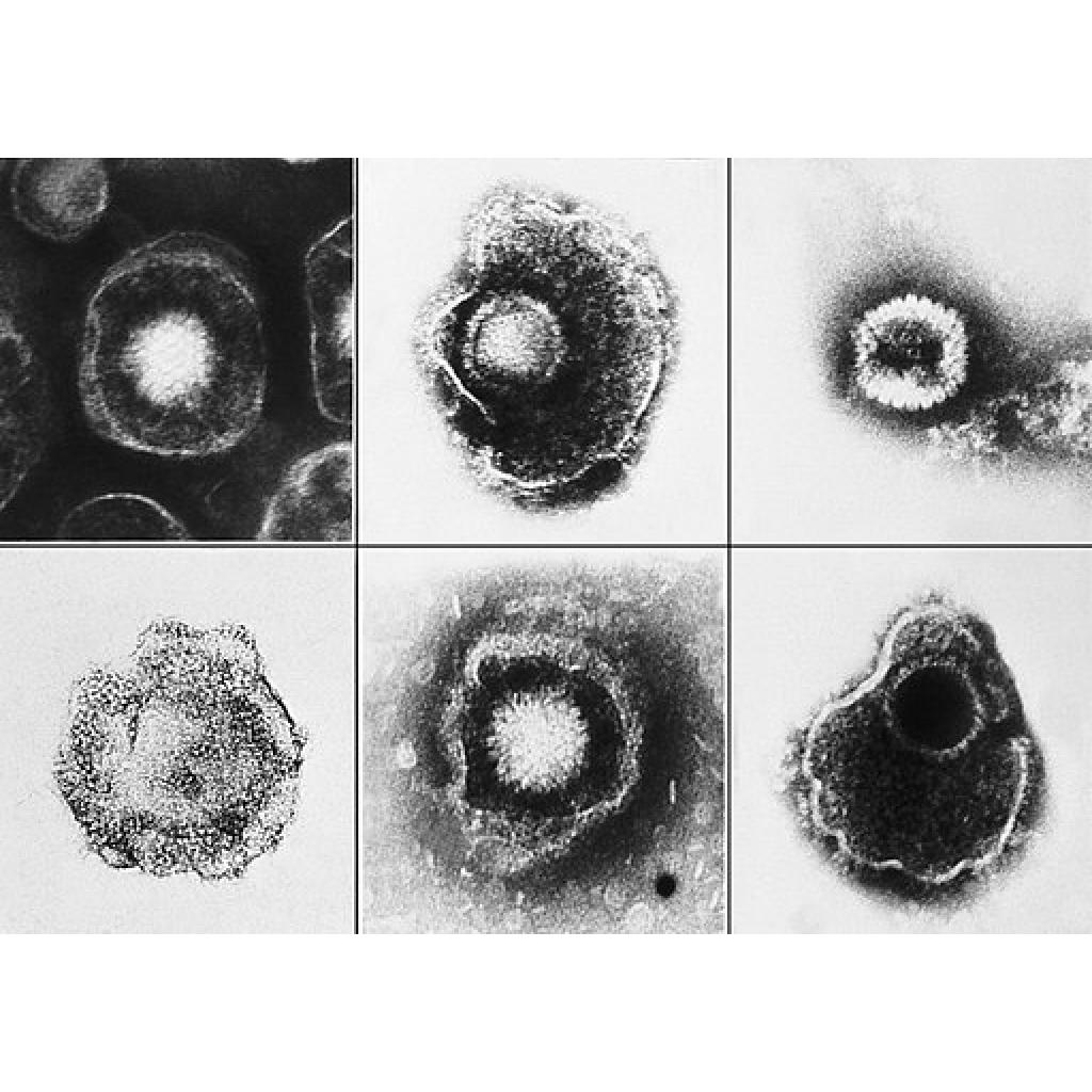 Nüfusun Büyük Bölümünü Enfekte Eden Sitomegalovirüs İntiharla İlişkilendirildi